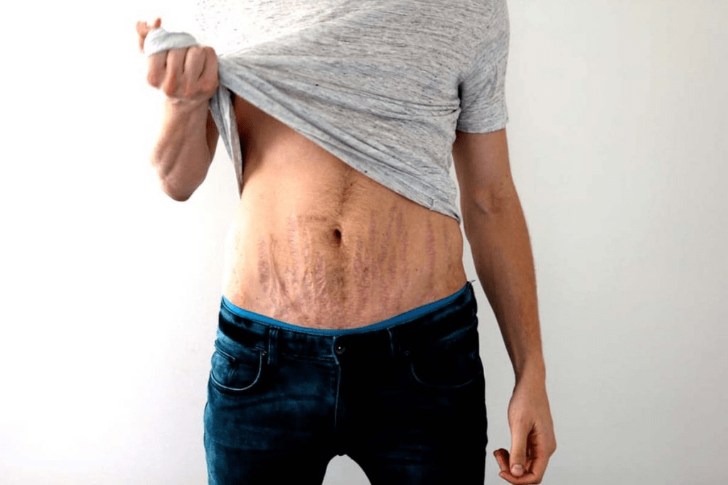 How To Avoid Getting Stretch Marks When Working Out